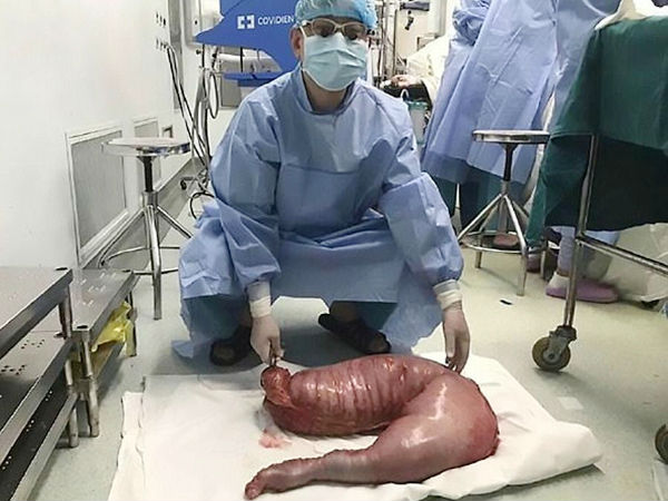 Doctors save man from deadly stomach ache by removing 13 kg feces-filled 'megacolon' Doctors save man from deadly stomach ache by removing 13 kg feces-filled 'megacolon'