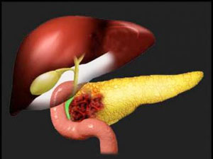 Pancreatic Cancer Pancreatic Cancer