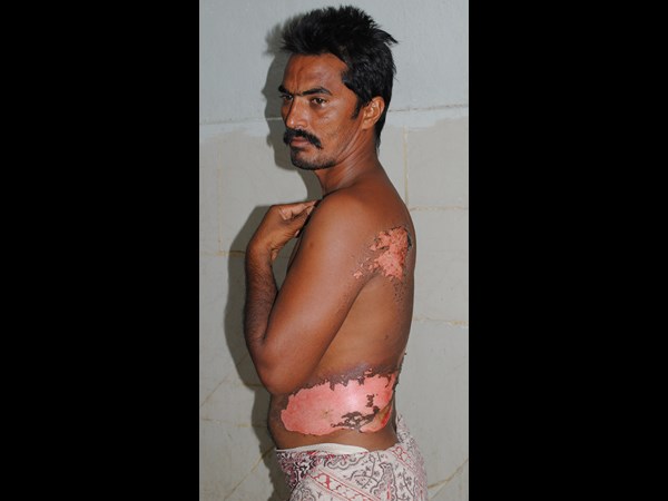 గాయాలు