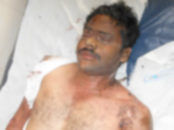 Photos: Acid attack on lecturer in Guntur Photos: Acid attack on lecturer in Guntur