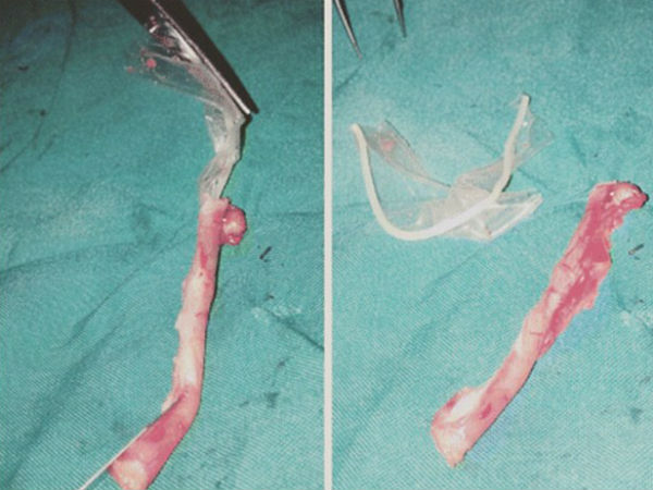 Woman was found to have a CONDOM stuck inside her appendix Woman was found to have a CONDOM stuck inside her appendix