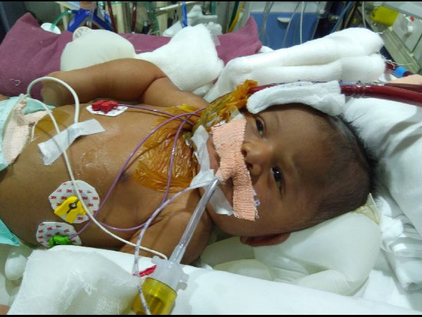 Neonatal ECMO performed at Hyderabad's KIMS Hospitals Neonatal ECMO performed at Hyderabad's KIMS Hospitals