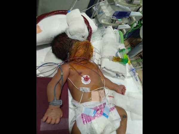 Neonatal ECMO performed at Hyderabad's KIMS Hospitals Neonatal ECMO performed at Hyderabad's KIMS Hospitals