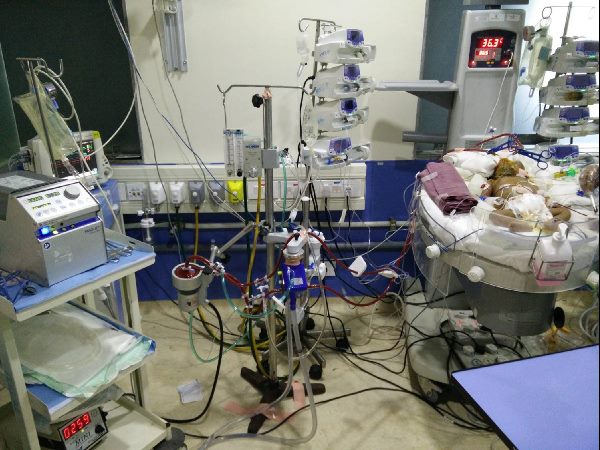 Neonatal ECMO performed at Hyderabad's KIMS Hospitals Neonatal ECMO performed at Hyderabad's KIMS Hospitals