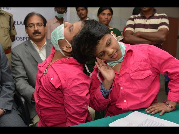 అవిభక్త కవలలు