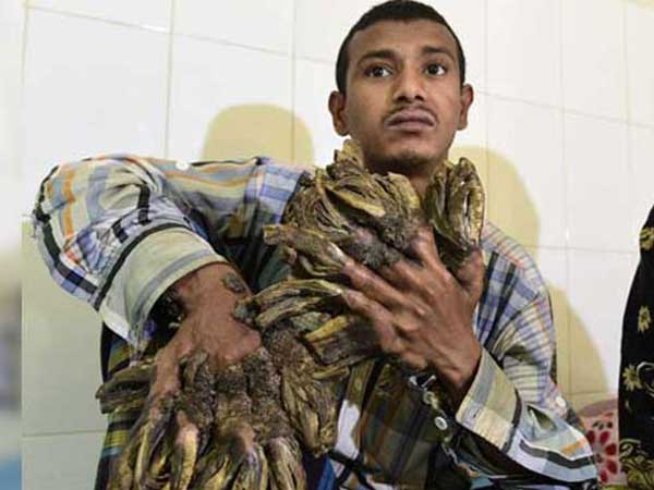 16 Surgeries for Tree Man In A Year 16 Surgeries for Tree Man In A Year