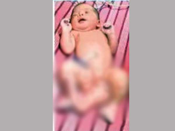 Baby born with three legs Baby born with three legs