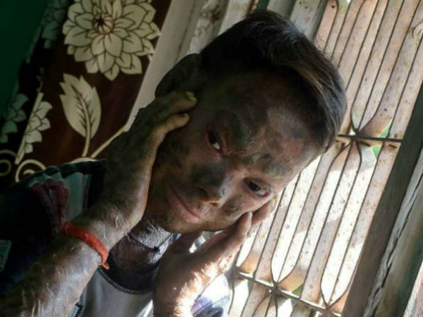 'Human snake' teen who sheds her skin every six weeks because of ultra-rare condition to get miracle treatment 'Human snake' teen who sheds her skin every six weeks because of ultra-rare condition to get miracle treatment