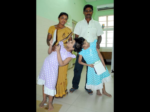 Telangana's Conjoined Twins Veena - Vani Celebrates 15th Birthday Telangana's Conjoined Twins Veena - Vani Celebrates 15th Birthday
