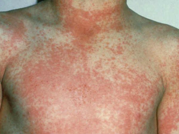The Once Deadly Scarlet Fever Is Making a Weird Comeback Around The World The Once Deadly Scarlet Fever Is Making a Weird Comeback Around The World