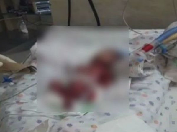 Parents Given 'Dead' Twins In Packet By Delhi Hospital, One Was Alive Parents Given 'Dead' Twins In Packet By Delhi Hospital, One Was Alive