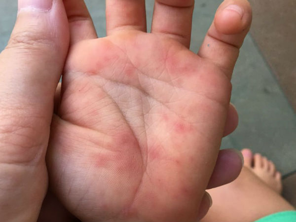 Many hand, foot and mouth disease cases being reported in guntur Many hand, foot and mouth disease cases being reported in guntur