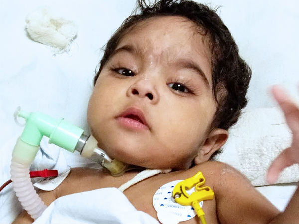 Even after 3 surgeries, this 1-year-old struggles for each breath Even after 3 surgeries, this 1-year-old struggles for each breath