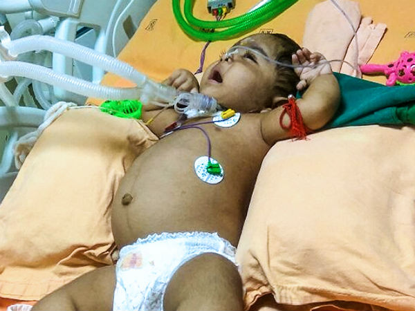 Even after 3 surgeries, this 1-year-old struggles for each breath Even after 3 surgeries, this 1-year-old struggles for each breath