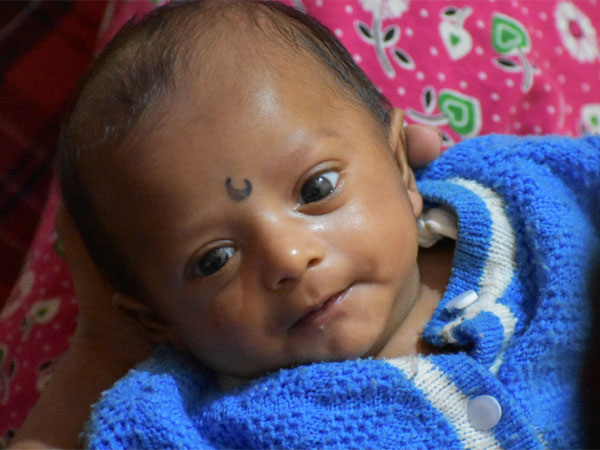 8 Month Old Anirudh Seeks Your Help For His Final Surgery 8 Month Old Anirudh Seeks Your Help For His Final Surgery