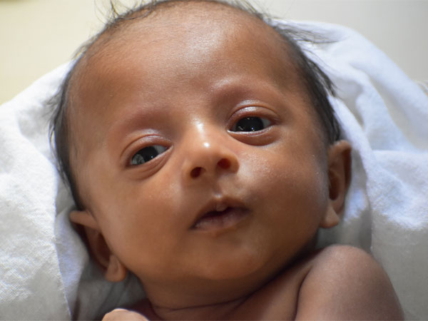 8 Month Old Anirudh Seeks Your Help For His Final Surgery 8 Month Old Anirudh Seeks Your Help For His Final Surgery