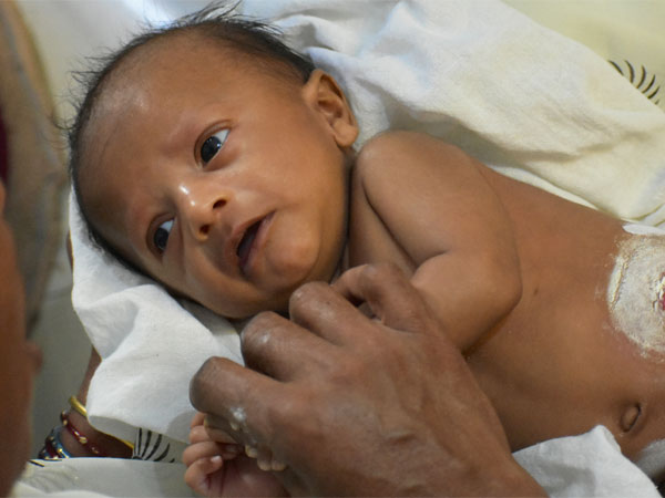 8 Month Old Anirudh Seeks Your Help For His Final Surgery 8 Month Old Anirudh Seeks Your Help For His Final Surgery