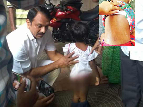 Daddy Burnt Me When I Was Eating, Hyderabad 4-Year-Old Tells Rescuers Daddy Burnt Me When I Was Eating, Hyderabad 4-Year-Old Tells Rescuers