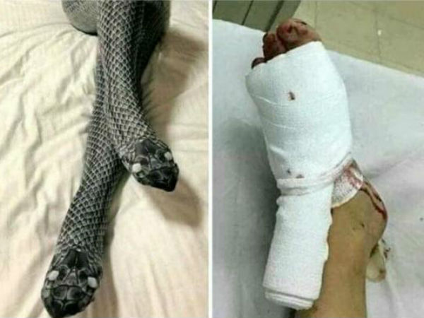 విరిగిపోయిన భార్య కాళ్లు