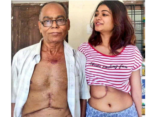 తండ్రికి, 65 శాతం కాలేయన్ని దానంగా ఇచ్చిన యువతి