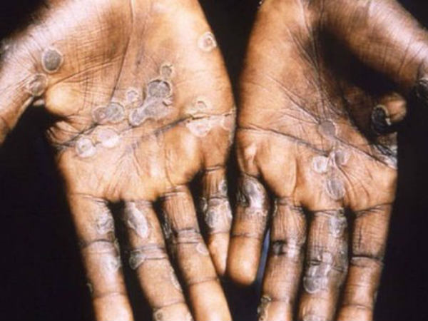 Singapore confirms case of monkeypox Singapore confirms case of monkeypox