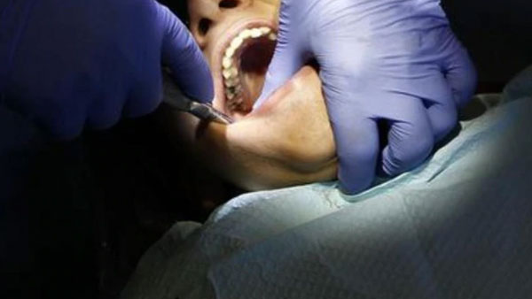 526 teeth in a 7-year-olds mouth! Chennai doctors remove them all 526 teeth in a 7-year-olds mouth! Chennai doctors remove them all