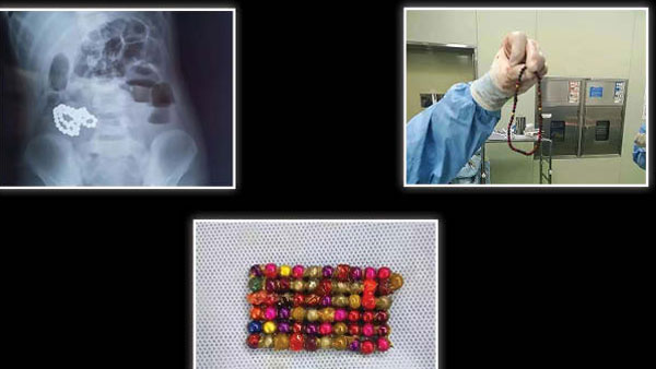 61 magnetic beads swallowed by Chinese boy, doctors remove after surgery 61 magnetic beads swallowed by Chinese boy, doctors remove after surgery