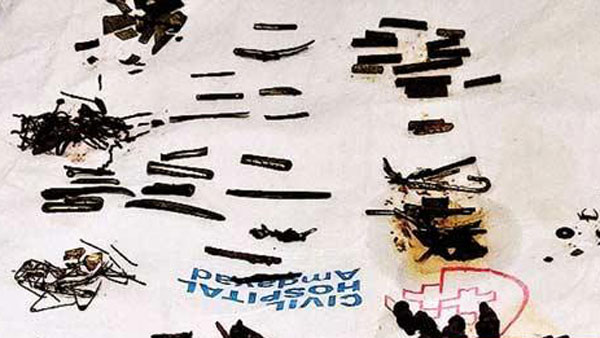 452 metal items found in ahmedabad man stomach 452 metal items found in ahmedabad man stomach