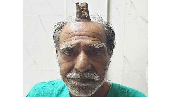 తలపై పెరిగిన కొమ్ము