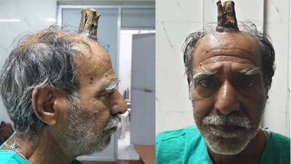 డెవిల్ హార్న్తో బాధపడిన శ్యాంలాల్