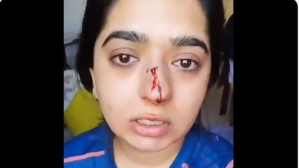Zomato delivery executive attacks Bengaluru woman, nasal bone fractured Zomato delivery executive attacks Bengaluru woman, nasal bone fractured
