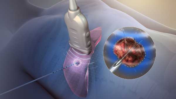 RFA procedure at Yashoda Hospitals helps Weightlifter Halavath Karthik recover back pain RFA procedure at Yashoda Hospitals helps Weightlifter Halavath Karthik recover back pain