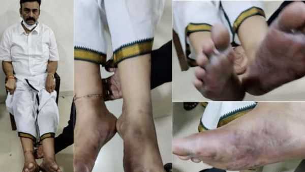 రెబల్ కాళ్లకు గాయాలపై..
