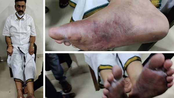 రఘురామ కాలికి ఫ్రాక్చర్