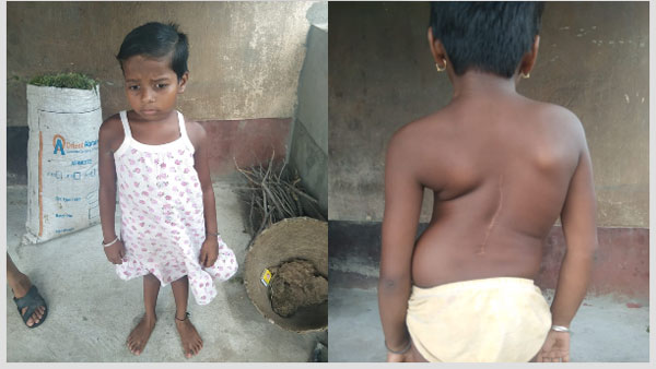 Help 9 year old West Bengals Disha recover from congenital scoliosis with tethered cord syndrome Help 9 year old West Bengals Disha recover from congenital scoliosis with tethered cord syndrome