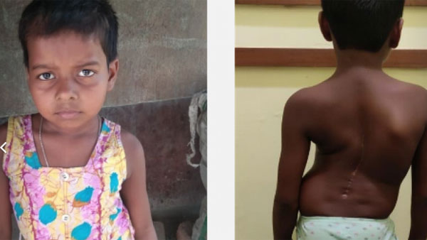 Help 9 year old West Bengals Disha recover from congenital scoliosis with tethered cord syndrome Help 9 year old West Bengals Disha recover from congenital scoliosis with tethered cord syndrome