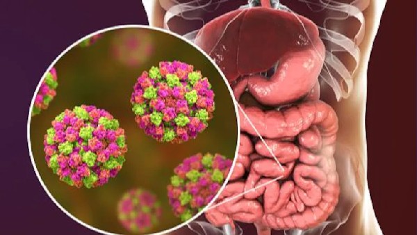 Kerala reports 13 cases of Norovirus Kerala reports 13 cases of Norovirus