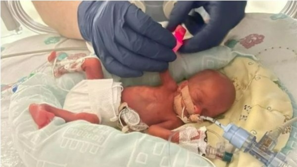 Birth of the smallest baby in the UK after 20 years; The weight is less than half kg!! Birth of the smallest baby in the UK after 20 years; The weight is less than half kg!!
