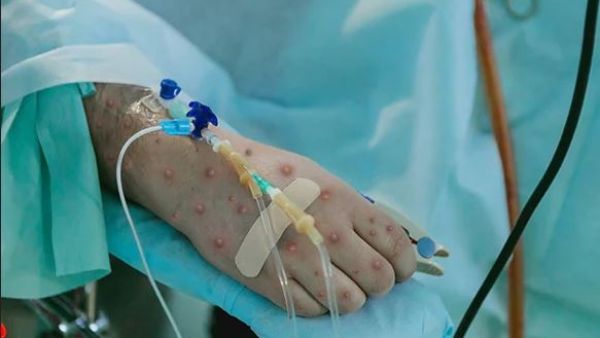 Monkeypox Declared Global Health Emergency: WHO Monkeypox Declared Global Health Emergency: WHO