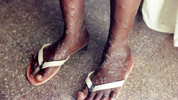 Monkeypox : WHO suggest men to limit sexual partners for now to avoid risk of new virus Monkeypox : WHO suggest men to limit sexual partners for now to avoid risk of new virus