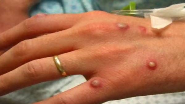  ఒకేవ్యక్తికి ఏకకాలంలో మంకీపాక్స్, హెచ్ఐవీ పాజిటివ్ మరియు కరోనా పాజిటివ్; ప్రపంచంలోనే తొలికేసు!!