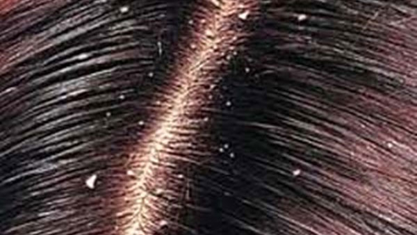  health tips: చుండ్రు సమస్యతో బాధ పడుతున్నారా? అయితే ఈ చిట్కాలు ట్రై చెయ్యండి!!