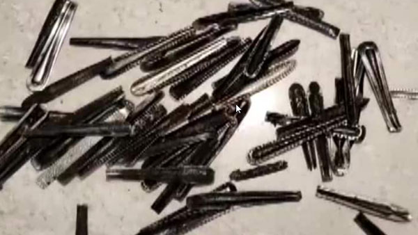 Doctors Remove 62 Steel Spoons From Mans Stomach, After Patient Complains Of Severe Pain Doctors Remove 62 Steel Spoons From Mans Stomach, After Patient Complains Of Severe Pain