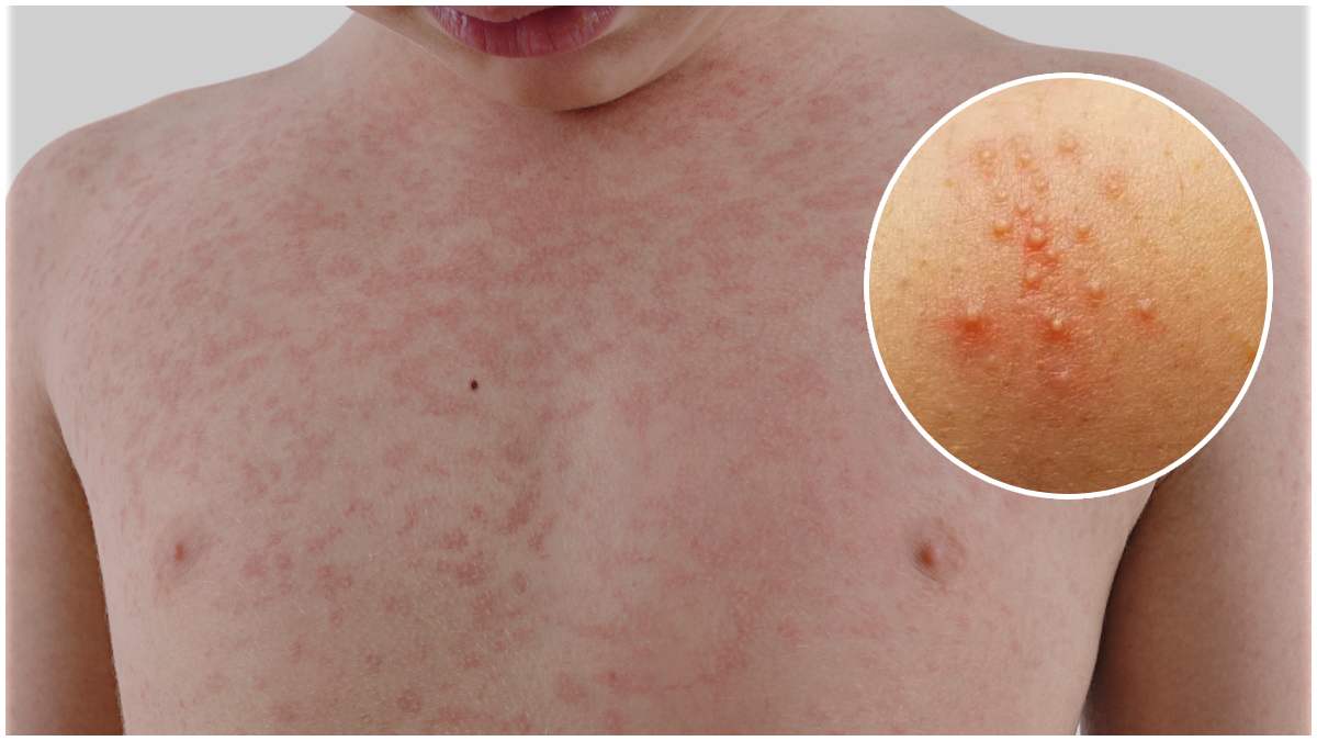 వేసవిలో చెమటకాయలు ఎక్కువైతే ఇలా చేయండి | home remedy to get rid of ...