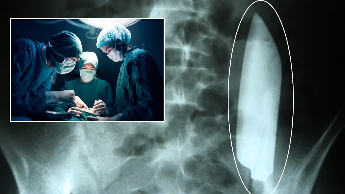 ఐదేళ్లుగా క‌డుపులో క‌త్తితో న‌ర‌కం అనుభ‌విస్తున్న యువ‌కుడు.. A young