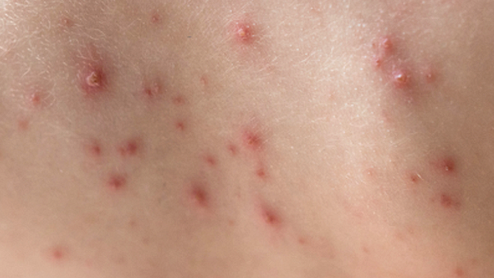 chickenpox chickenpox