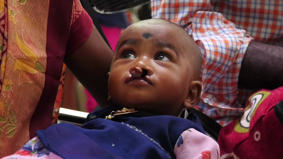 గ్రహణమొర్రి గ్రహణమొర్రి