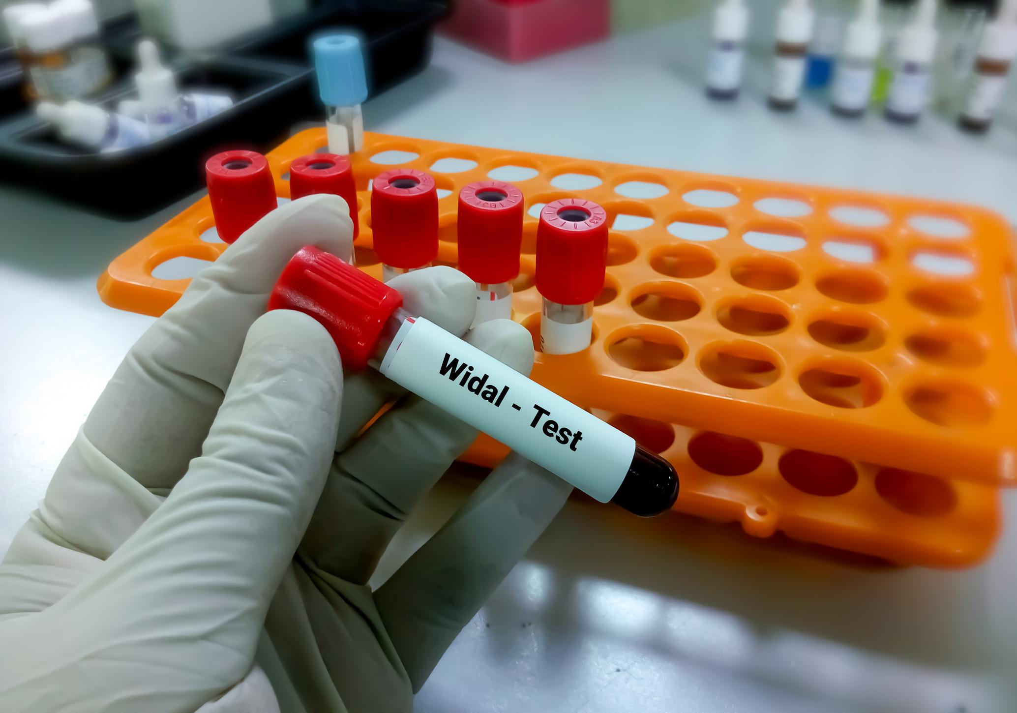 టైఫాయిడ్: వర్షాకాలంలో విజృంభించే ఈ వ్యాధి బారిన పడకుండా ఎలాంటి జాగ్రత్తలు తీసుకోవాలి?