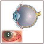 conjuctivitis